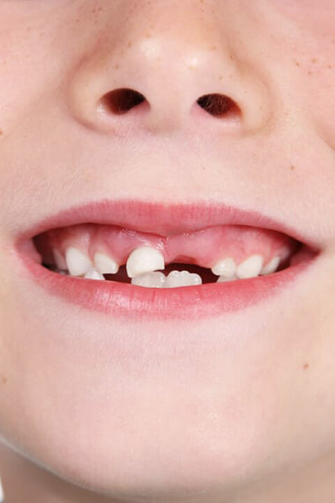Child's smile showing mixed primary and permanent teeth during dental development stage.