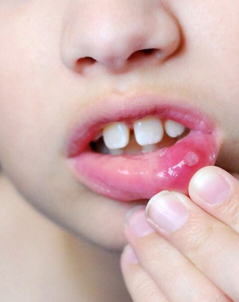 Child's mouth showing baby teeth with finger pointing to tooth, demonstrating dental examination or tooth care.